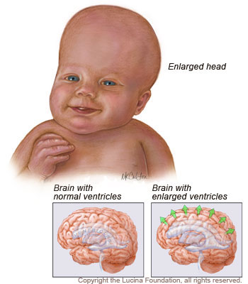 hydrocephalus baby signs